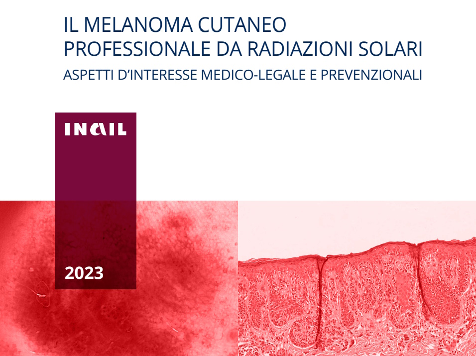 Melanoma cutaneo professionale da radiazioni solari. aspetti di spiccato interesse medico-legale. Scarica Portaleconsulenti